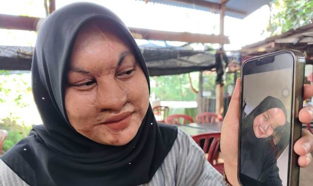 Sakit tiada noktah: Luka disimbah cuka getah oleh ayah masih terasa